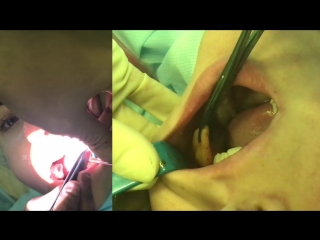 bish's lumps - buccal fat removal